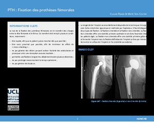 "Prothèse totale de hanche (PTH) : Fixation des prothèses fémorales" icon