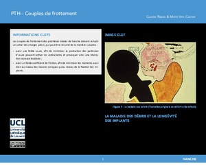"Prothèse totale de hanche (PTH): couples de frottement" icon